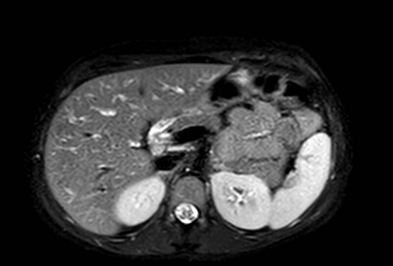File:Appendicitis in gravida (MRI) (Radiopaedia 89433-106395 Axial T2 SPAIR 21).jpg