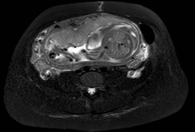 File:Appendicitis in gravida (MRI) (Radiopaedia 89433-106395 Axial T2 SPAIR 47).jpg