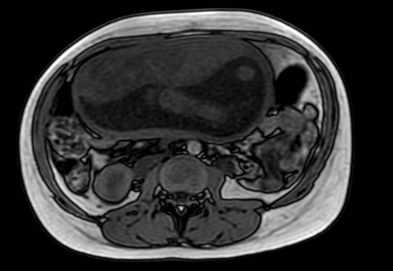 File:Appendicitis in gravida (MRI) (Radiopaedia 89433-106395 D 31).jpg