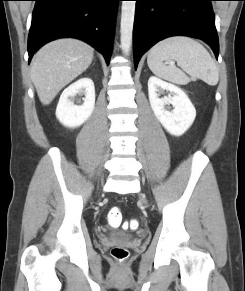 File:Appendicitis with cecal bar sign (Radiopaedia 31878-32830 A 41).jpg