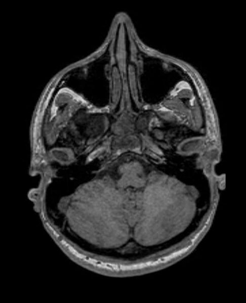 File:Arachnoid cyst- extremely large (Radiopaedia 68741-78451 Axial T1 17).jpg