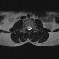 Arachnoid cyst - spinal (Radiopaedia 66835-76157 Axial T2 18).jpg