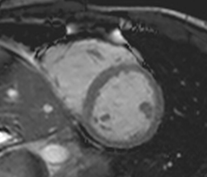 File:Arrhythmogenic right ventricular cardiomyopathy (Radiopaedia 39806-42237 F 28).jpg