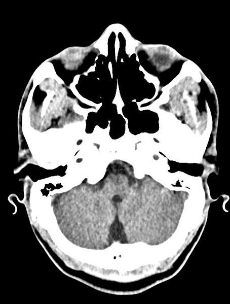File:Arrow injury to the head (Radiopaedia 75266-86388 Axial non-contrast 9).jpg