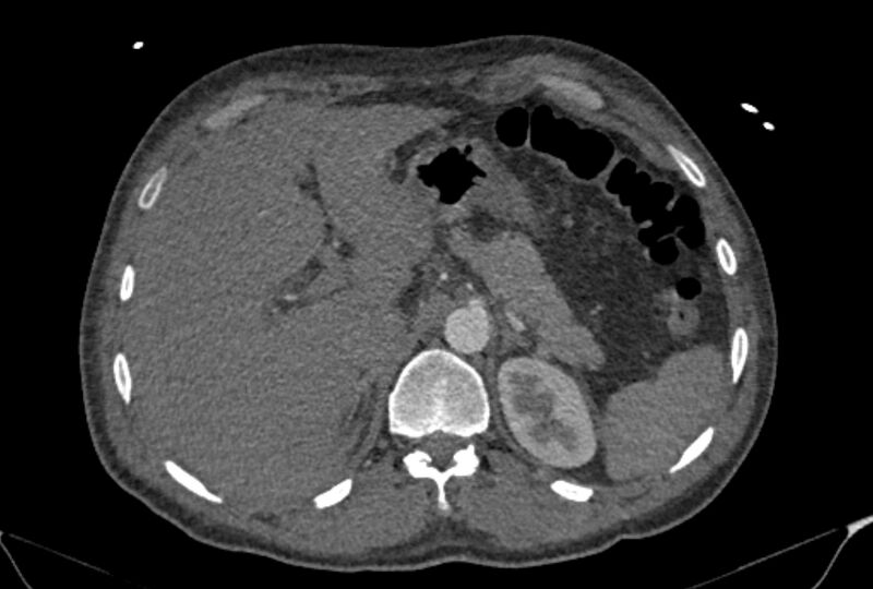 File:Ascending aortic aneurysm (Radiopaedia 86279-102297 C 68).jpg