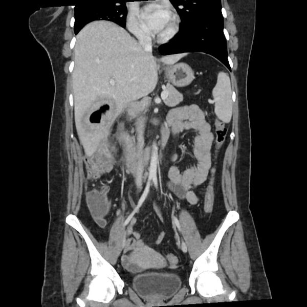 File:Ascending retrocecal appendicitis with liver abscesses (Radiopaedia 60066-67615 C 21).jpg
