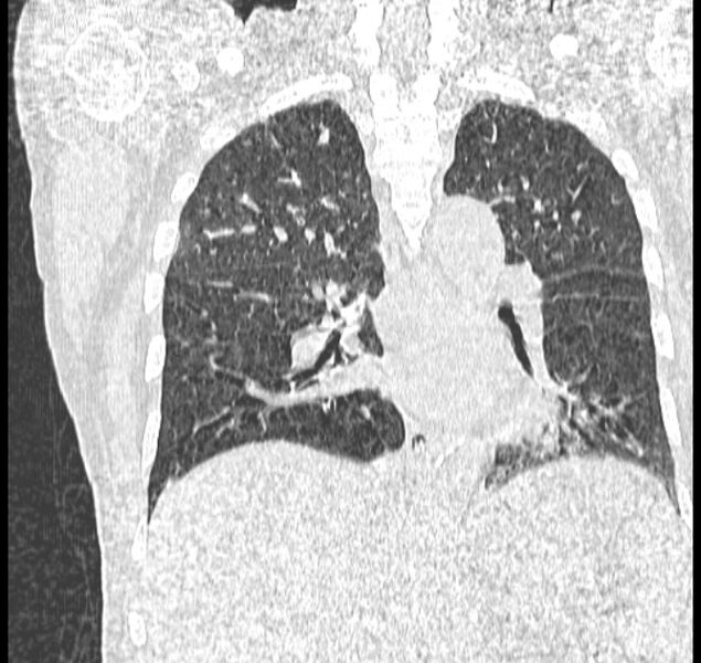 File:Aspergilloma (Radiopaedia 44592-48327 Coronal lung window 78).jpg