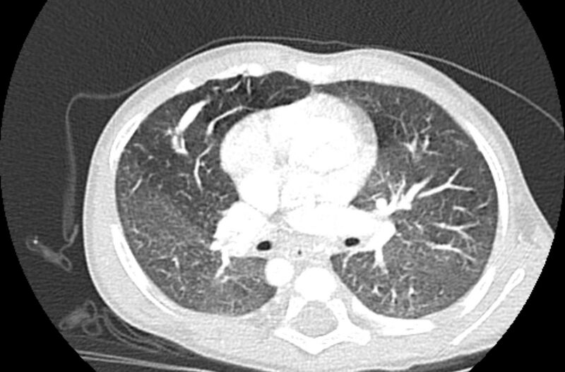 File:Asplenia syndrome (Radiopaedia 73083-83792 Axial lung window 31).jpg