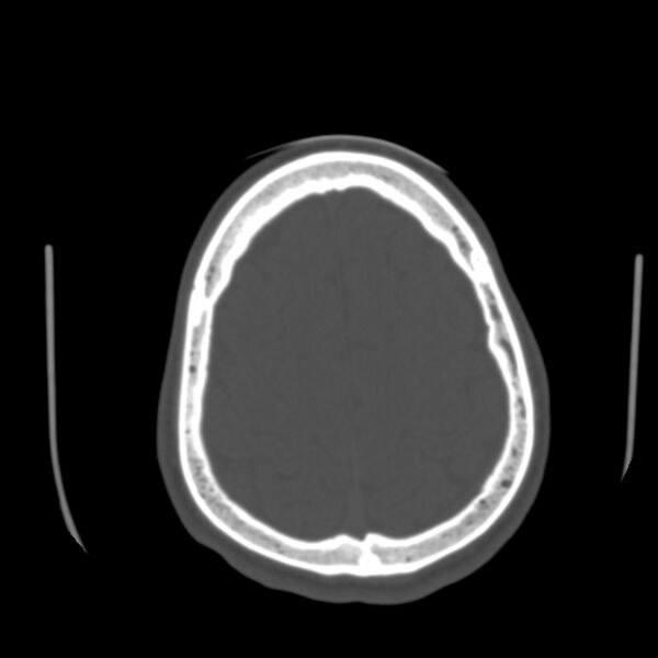 File:Asymptomatic occipital spur (Radiopaedia 87753-104201 Axial bone window 173).jpg