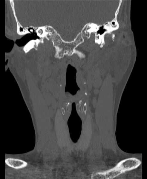 File:Atlanto-occipital assimilation with basilar invagination (Radiopaedia 70122-80188 Coronal bone window 37).jpg