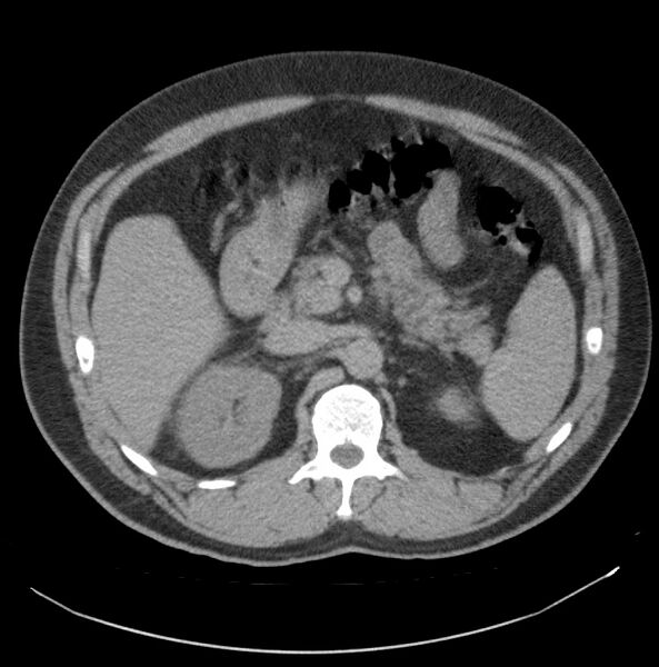 File:Atrophic kidney due to severe chronic obstructive hydronephrosis (Radiopaedia 40828-43474 Axial non-contrast 1).jpg