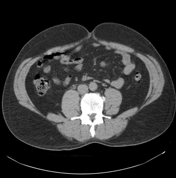 File:Atrophic kidney due to severe chronic obstructive hydronephrosis (Radiopaedia 40828-43474 Axial non-contrast 18).jpg