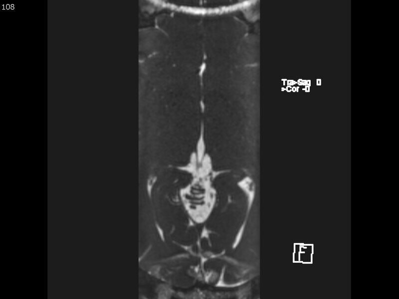 File:Atypical meningioma - intraosseous (Radiopaedia 64915-74572 Axial CISS 108).jpg
