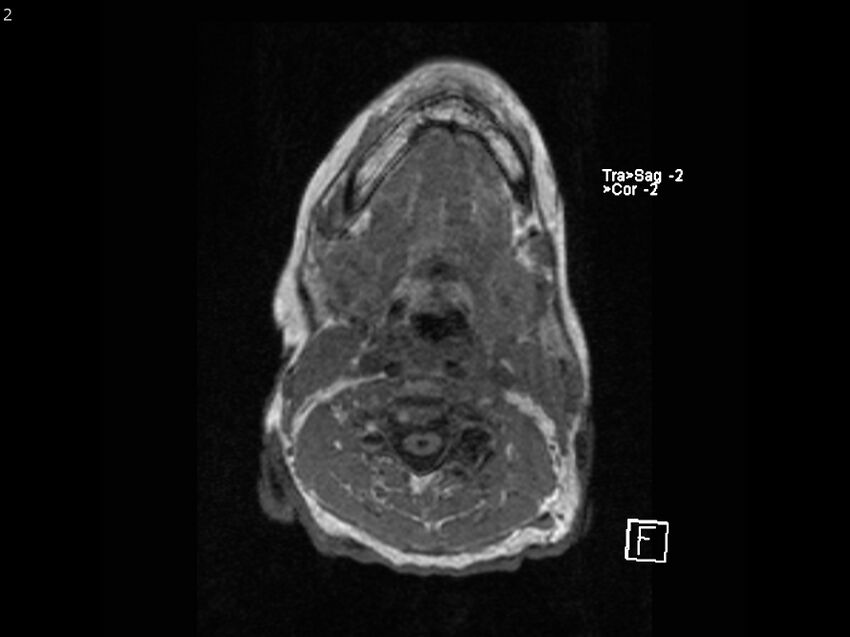 Atypical meningioma - intraosseous (Radiopaedia 64915-74572 Axial T1 2).jpg