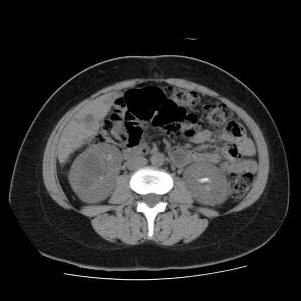 File:Autosomal dominant polycystic kidney disease (Radiopaedia 23061-23093 Axial non-contrast 34).jpg