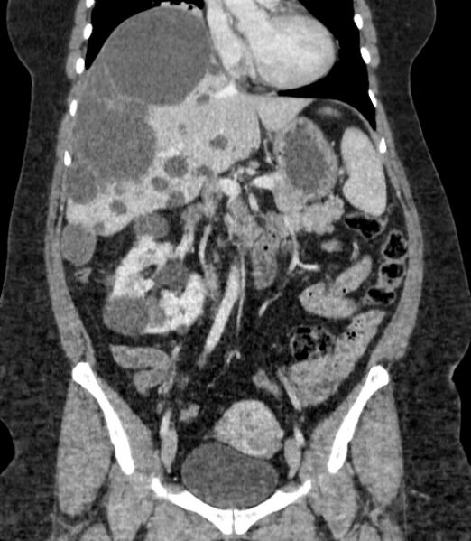 File:Autosomal dominant polycystic kidney disease (Radiopaedia 57124-64017 B 36).jpg