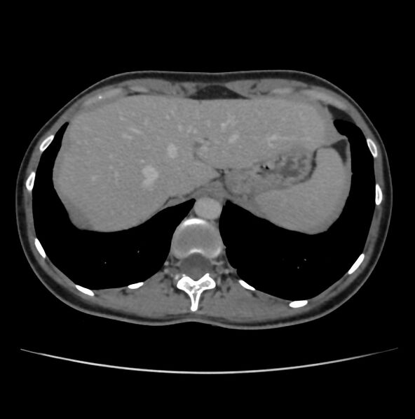 File:Autosomal dominant polycystic kidney disease - early onset (Radiopaedia 40734-43387 A 2).jpg