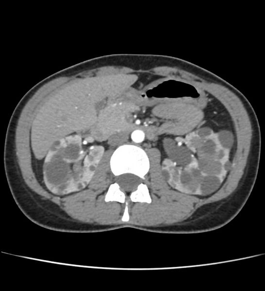 File:Autosomal dominant polycystic kidney disease - early onset (Radiopaedia 40734-43387 B 23).jpg