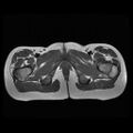 Avascular necrosis of the hip (Radiopaedia 29563-30067 Axial T1 15).jpg