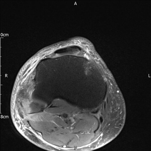 File:Avulsion fracture of the fibular head (Radiopaedia 74804-85808 Axial PD fat sat 30).jpg