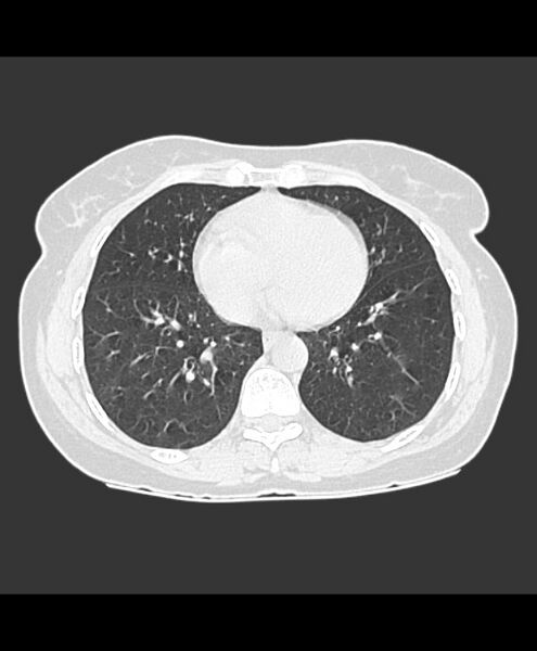 File:Azygos fissure and azygos lobe (Radiopaedia 41841-44832 Axial lung window 7).jpg