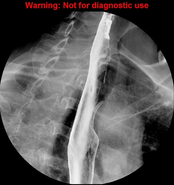 File:Barrett esophagus (Radiopaedia 44421-48075 A 1).jpg