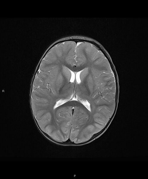 File:Basal ganglia and parenchymal ischemia (Radiopaedia 45818-50084 Axial T2 12).jpg