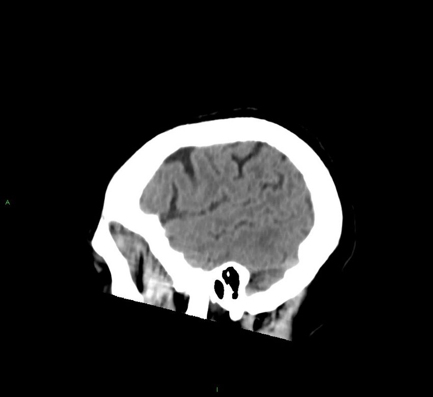 Basal ganglia hemorrhage (Radiopaedia 58763-65985 C 50).jpg