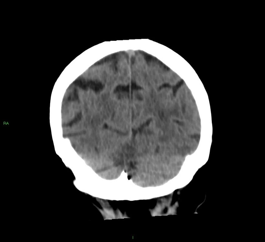 Basal ganglia hemorrhage (Radiopaedia 58790-66024 Coronal non-contrast 14).jpg