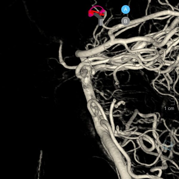 File:Basilar artery perforator aneurysm (Radiopaedia 82455-97734 3D view left VA 16).jpg