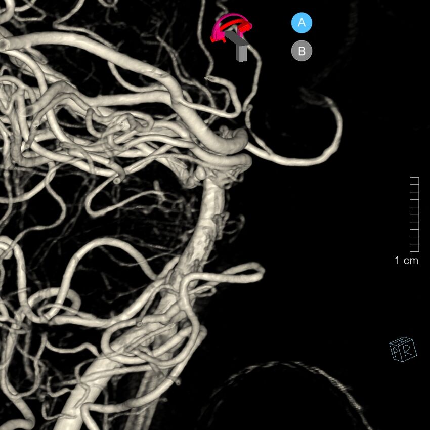 Basilar artery perforator aneurysm (Radiopaedia 82455-97734 3D view left VA 72).jpg