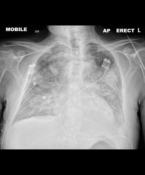 File:Bat wings of pulmonary edema (Radiopaedia 88933-105758 Frontal 1).jpg