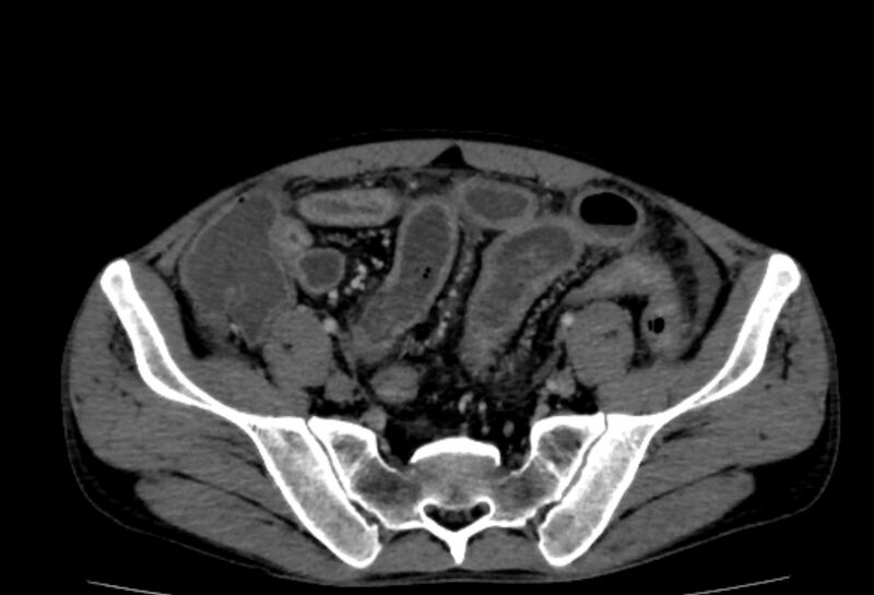 File:Behçet's disease. abdominal vasculitis (Radiopaedia 55955-62570 Axial 32).jpg