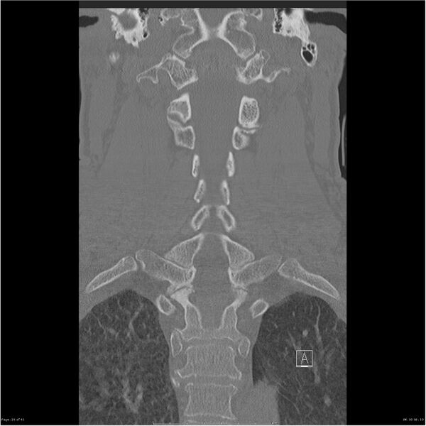 File:Bilateral cervical ribs (Radiopaedia 25868-26017 Coronal bone window 25).jpg