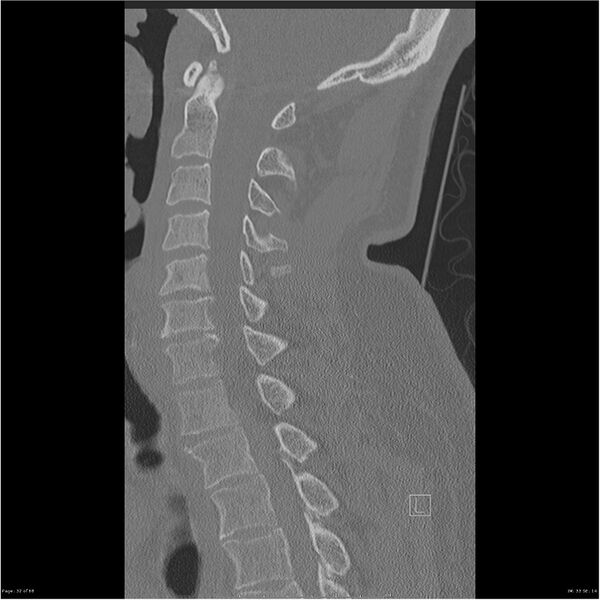 File:Bilateral cervical ribs (Radiopaedia 25868-26017 Sagittal bone window 32).jpg