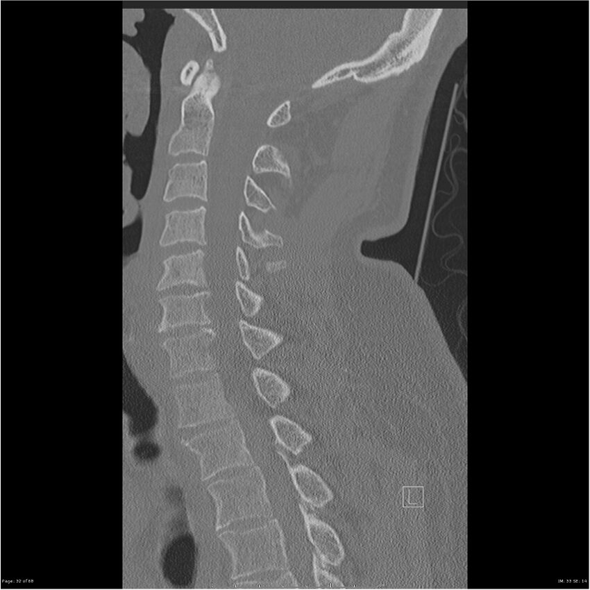 Bilateral cervical ribs (Radiopaedia 25868-26017 Sagittal bone window 32).jpg
