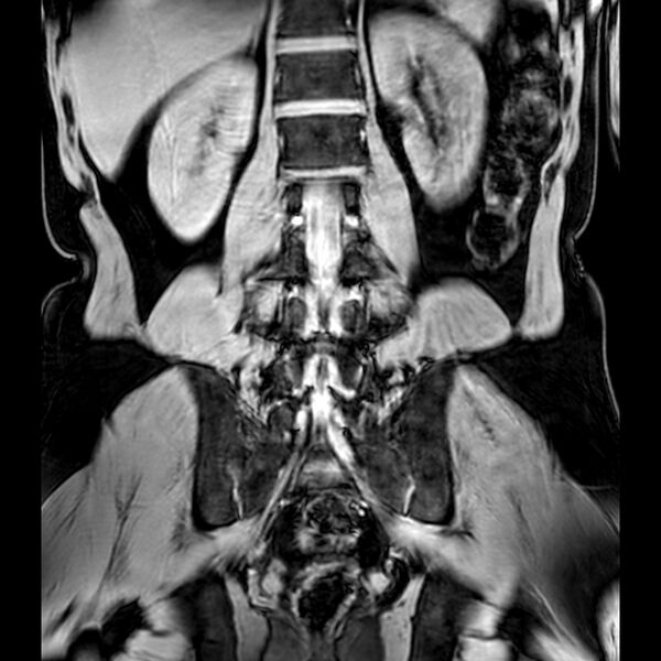 File:Bilateral conjoined nerve roots at different levels (Radiopaedia 73312-84063 Coronal WE 33).jpg