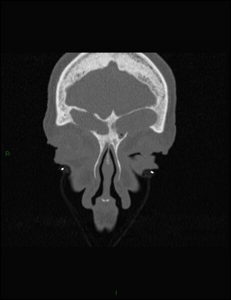 File:Bilateral frontal mucoceles (Radiopaedia 82352-96454 Coronal 64).jpg