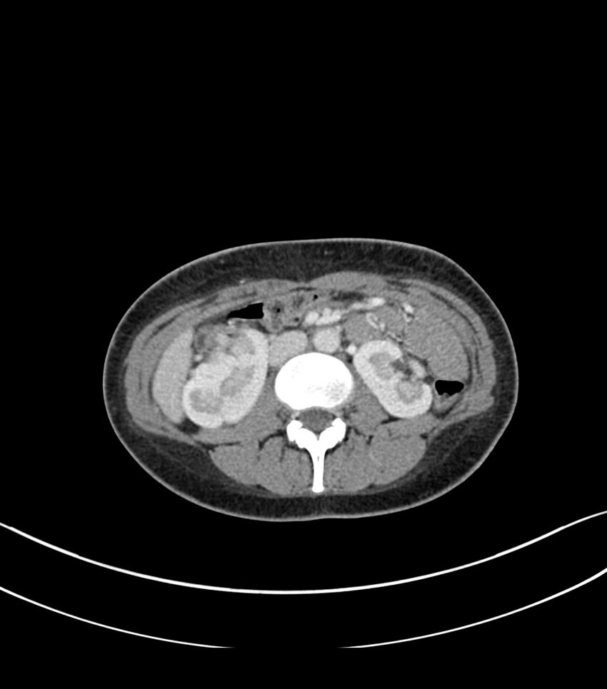 Bilateral kidney malrotation (Radiopaedia 72227-82749 A 25).jpg