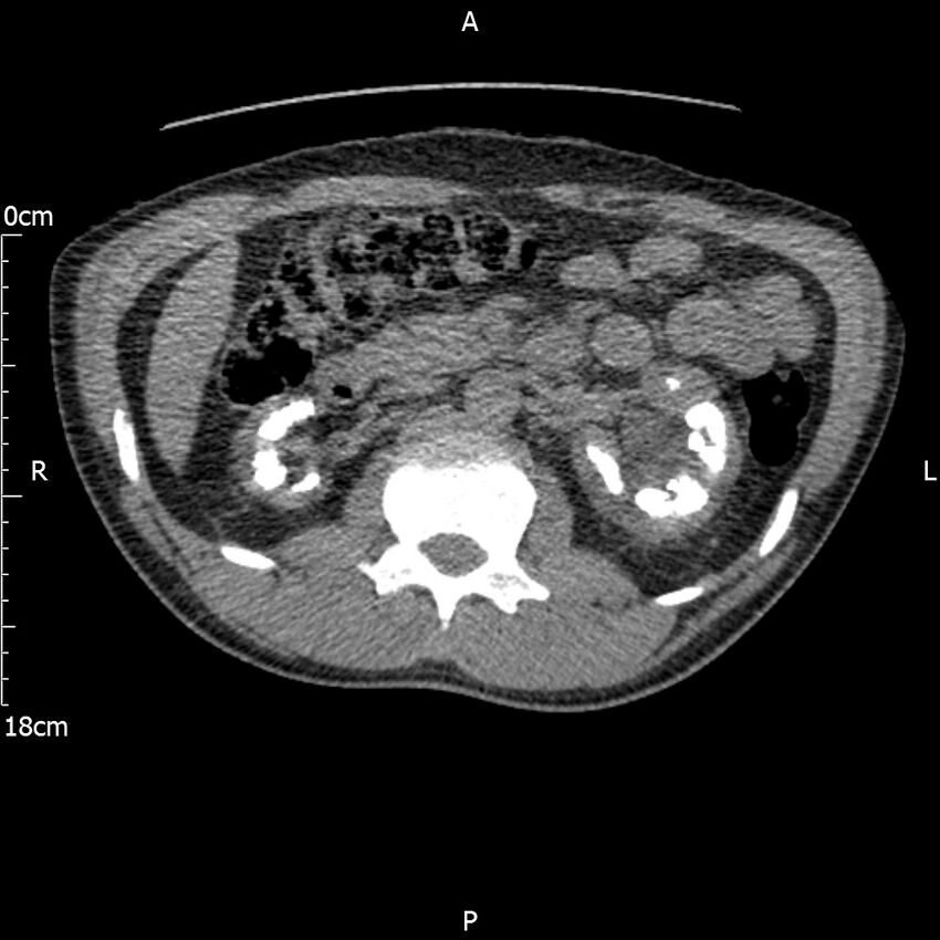Bilateral medullary nephrocalcinosis with ureteric calculi (Radiopaedia 71269-81569 Axial non-contrast 43).jpg