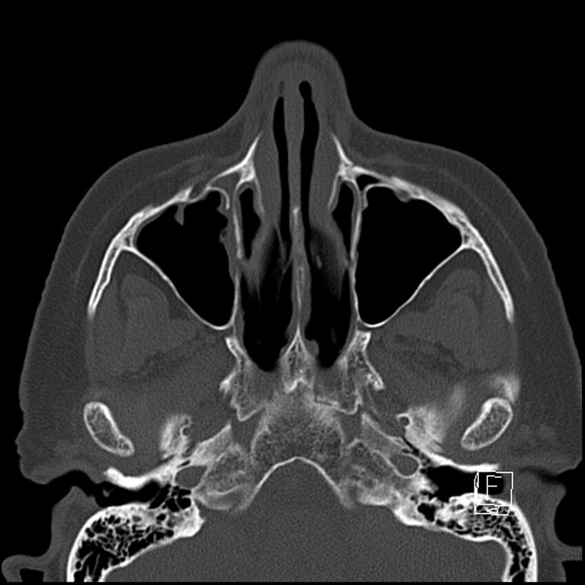 Bilateral palatine tonsilloliths on OPG and CT (Radiopaedia 75167-86247 Axial bone window 20).jpg