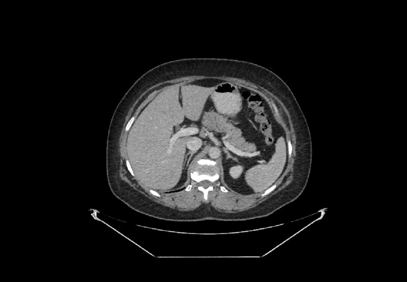 File:Bilateral urolithiasis with incidentally detected splenic artery aneurysm and left inferior vena cava (Radiopaedia 44467-48127 B 14).jpg