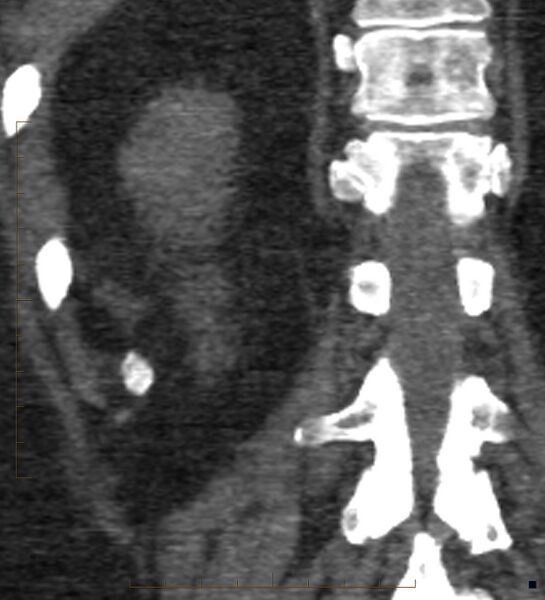 File:Bile leak from accessory duct(s) of Luschka post cholecystectomy (Radiopaedia 40736-43389 B 63).jpg