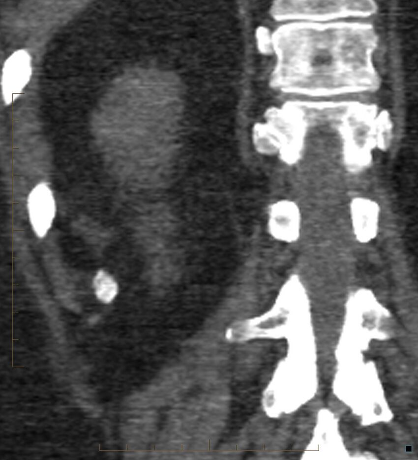 Bile leak from accessory duct(s) of Luschka post cholecystectomy (Radiopaedia 40736-43389 B 63).jpg