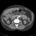 Biliary necrosis - liver transplant (Radiopaedia 21876-21845 A 29).jpg