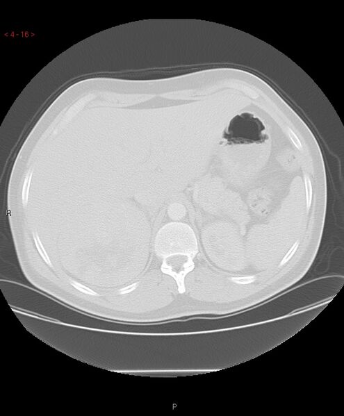 File:Birt-Hogg-Dubé syndrome (Radiopaedia 53814-60013 Axial lung window 16).jpg