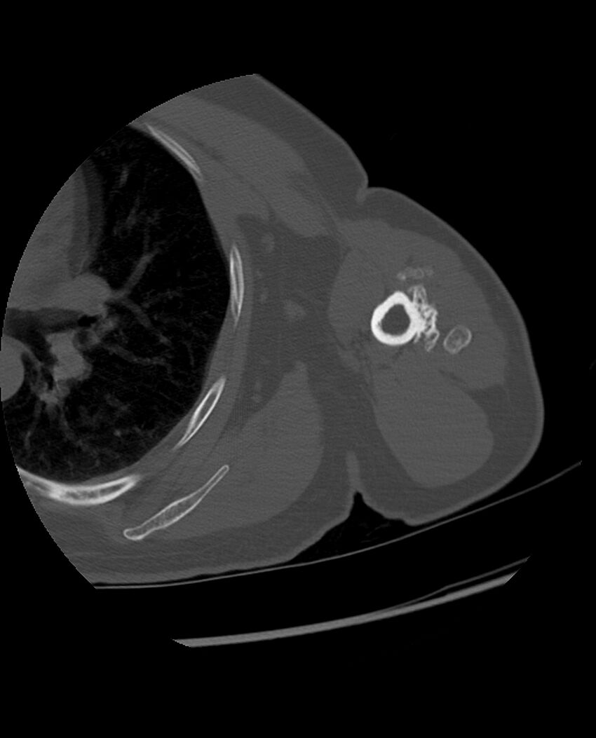 Bizarre parosteal osteochondromatous proliferation (Radiopaedia 84221-99501 Axial bone window 62).jpg
