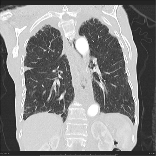 File:Boerhaave syndrome (Radiopaedia 26240-26362 Coronal lung window 22).jpg