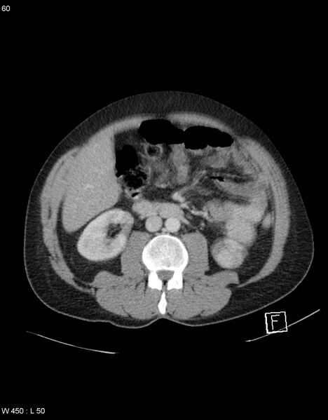 File:Boerhaave syndrome with tension pneumothorax (Radiopaedia 56794-63603 A 30).jpg