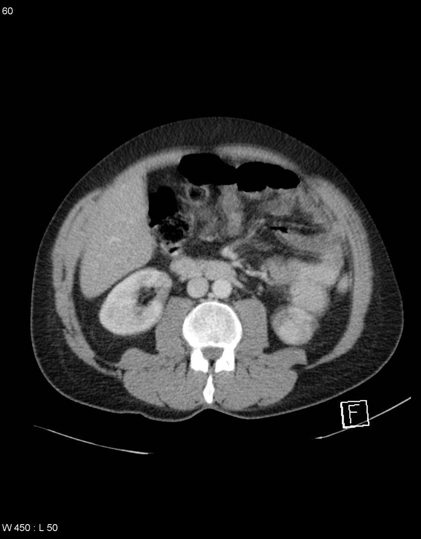 Boerhaave syndrome with tension pneumothorax (Radiopaedia 56794-63603 A 30).jpg
